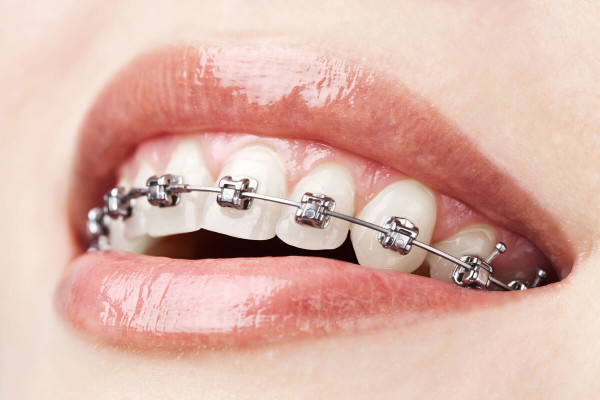 Брекеты или имплант: что выбрать, если удалили зуб в детстве?